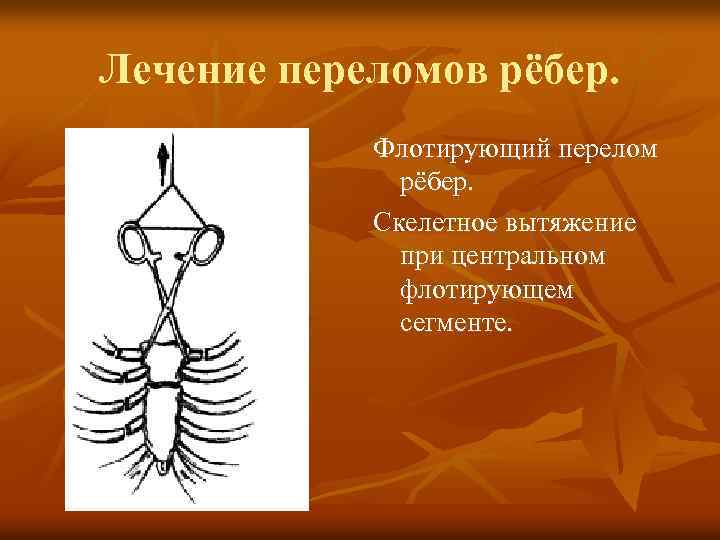 Лечение переломов рёбер. Флотирующий перелом рёбер. Скелетное вытяжение при центральном флотирующем сегменте. 