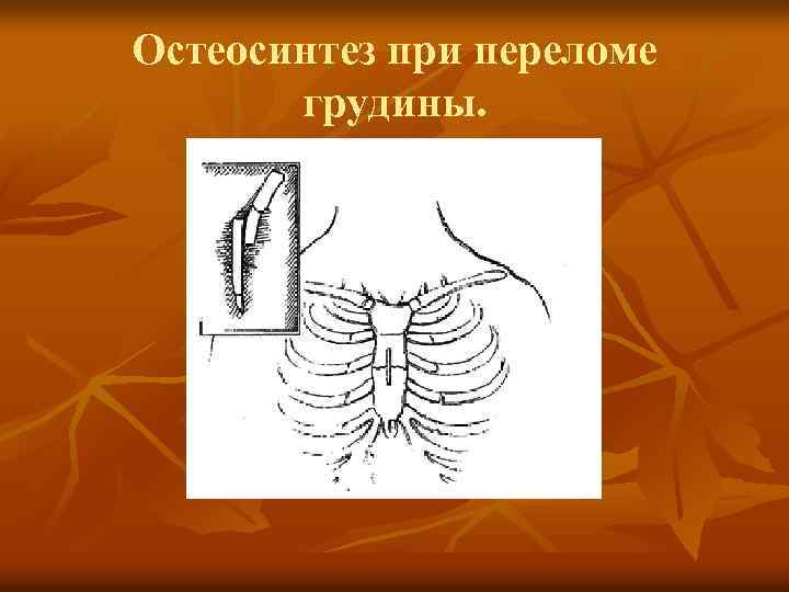 Остеосинтез при переломе грудины. 