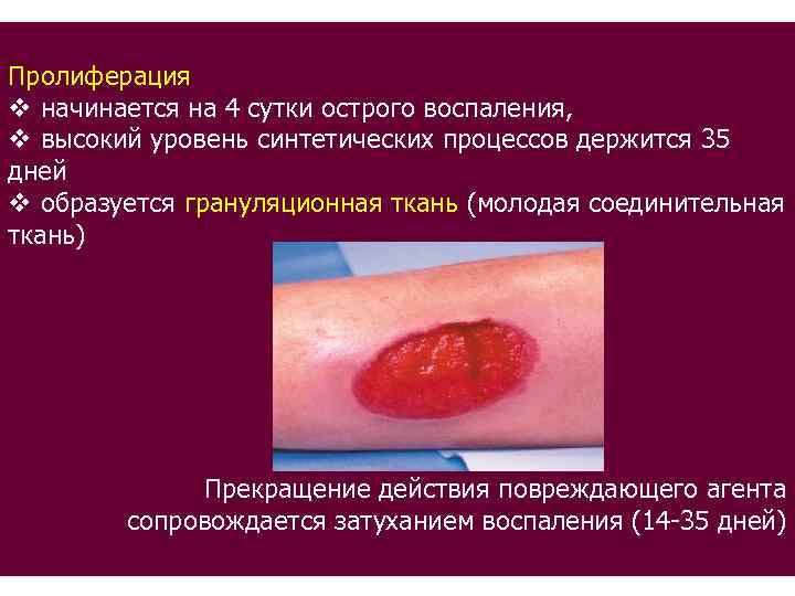 Пролиферация v начинается на 4 сутки острого воспаления, v высокий уровень синтетических процессов держится