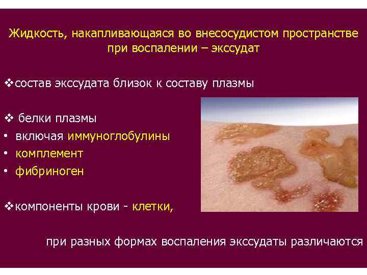 Жидкость, накапливающаяся во внесосудистом пространстве при воспалении – экссудат vсостав экссудата близок к составу