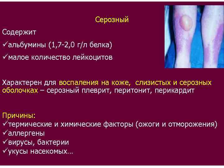 Серозный Содержит üальбумины (1, 7 -2, 0 г/л белка) üмалое количество лейкоцитов Характерен для