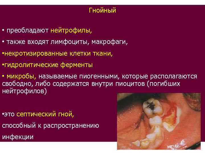 Гнойный • преобладают нейтрофилы, • также входят лимфоциты, макрофаги, • некротизированные клетки ткани, •