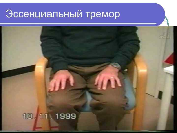 Эссенциальный тремор 