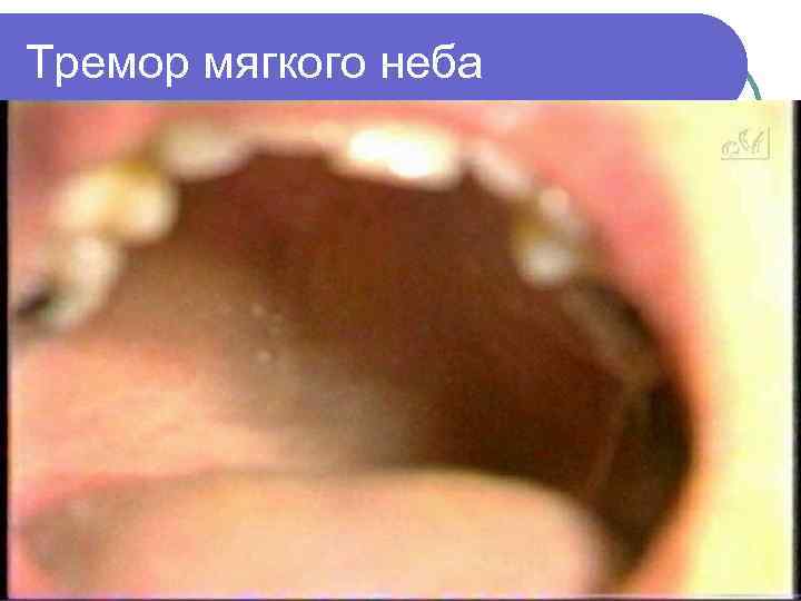 Тремор мягкого неба 