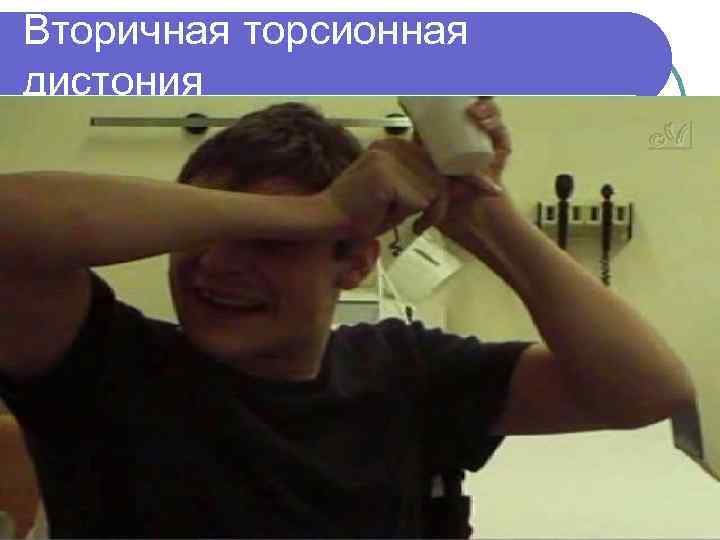 Вторичная торсионная дистония 