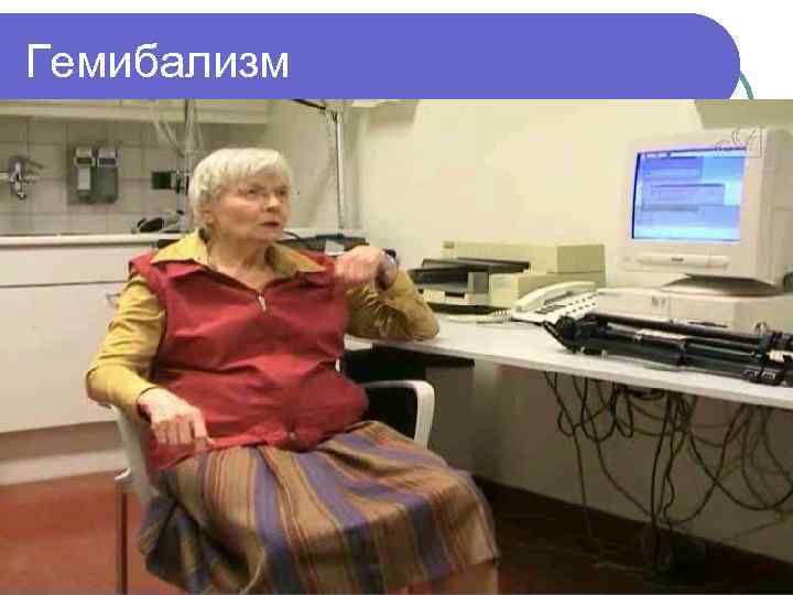 Гемибализм 