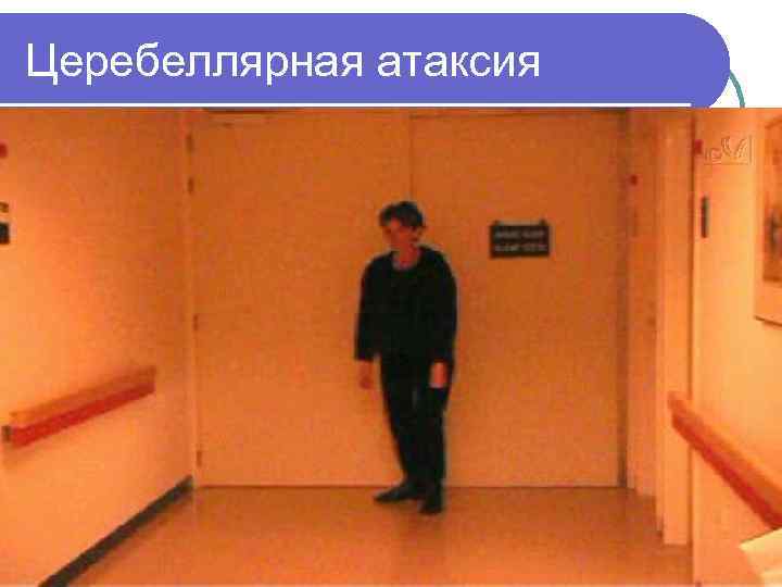 Церебеллярная атаксия 