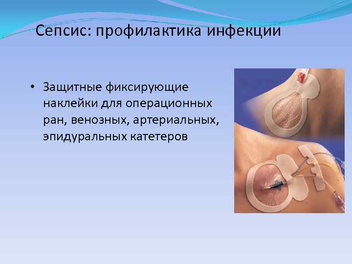 Сепсис: профилактика инфекции • Защитные фиксирующие наклейки для операционных ран, венозных, артериальных, эпидуральных катетеров