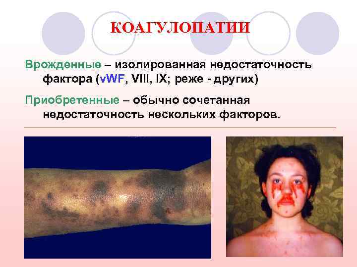 КОАГУЛОПАТИИ Врожденные – изолированная недостаточность фактора (v. WF, VIII, IX; реже - других) Приобретенные