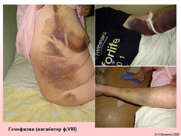 Гемофилия (ингибитор ф. VIII) А. Н. Мамаев 2006 
