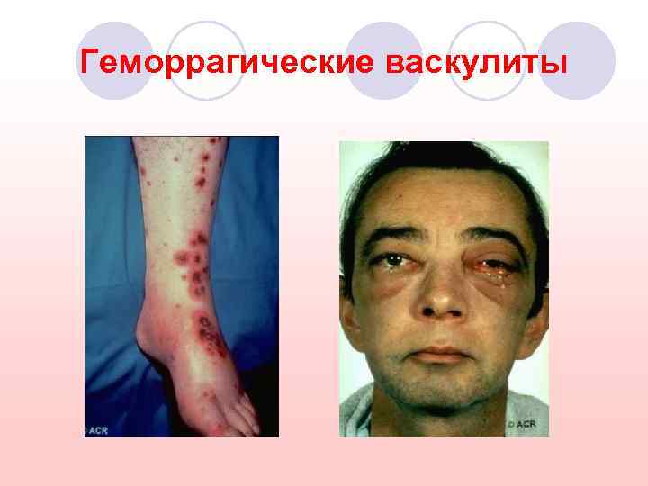 Геморрагические васкулиты 