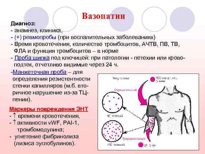 Вазопатии Диагноз: - анамнез, клиника, - (+) ревмопробы (при воспалительных заболеваниях) - Время кровотечения,
