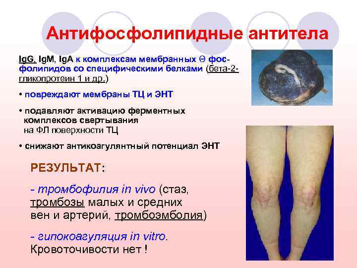 Антифосфолипидные антитела Ig. G, Ig. M, Ig. A к комплексам мембранных Θ фосфолипидов со