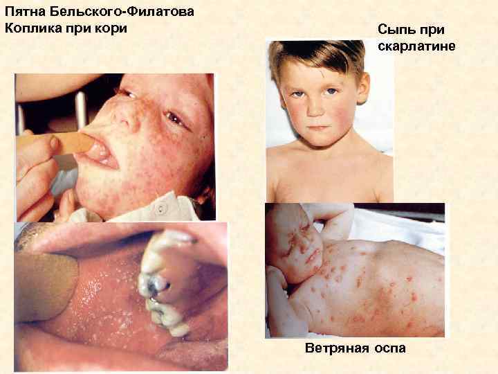 Пятна Бельского-Филатова Коплика при кори Сыпь при скарлатине Ветряная оспа 