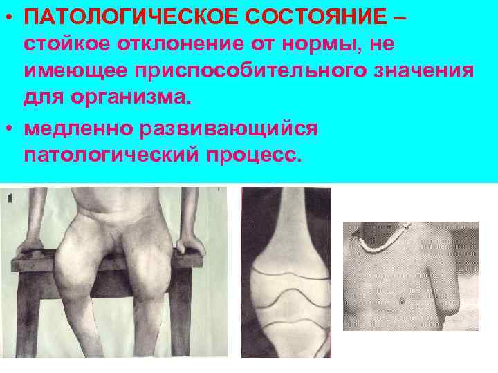  • ПАТОЛОГИЧЕСКОЕ СОСТОЯНИЕ – стойкое отклонение от нормы, не имеющее приспособительного значения для