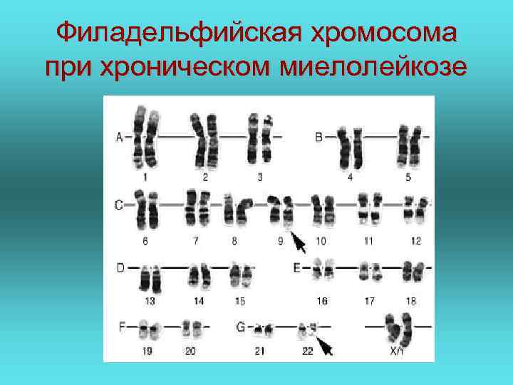 Филадельфийская хромосома при хроническом миелолейкозе 