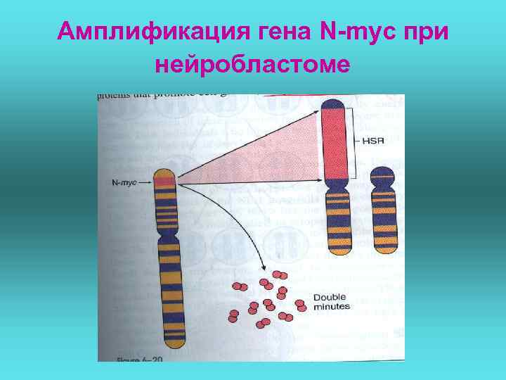 Амплификация гена N-myc при нейробластоме 