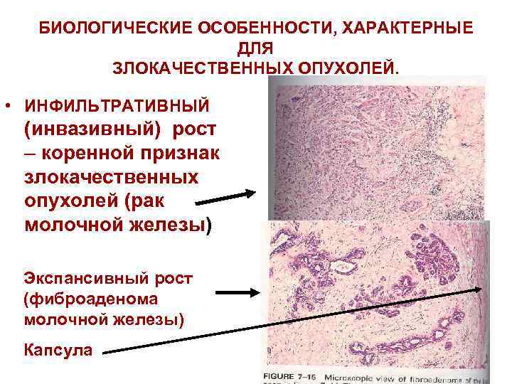 БИОЛОГИЧЕСКИЕ ОСОБЕННОСТИ, ХАРАКТЕРНЫЕ ДЛЯ ЗЛОКАЧЕСТВЕННЫХ ОПУХОЛЕЙ. • ИНФИЛЬТРАТИВНЫЙ (инвазивный) рост – коренной признак злокачественных