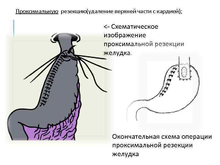 Результаты после резекции желудка фото