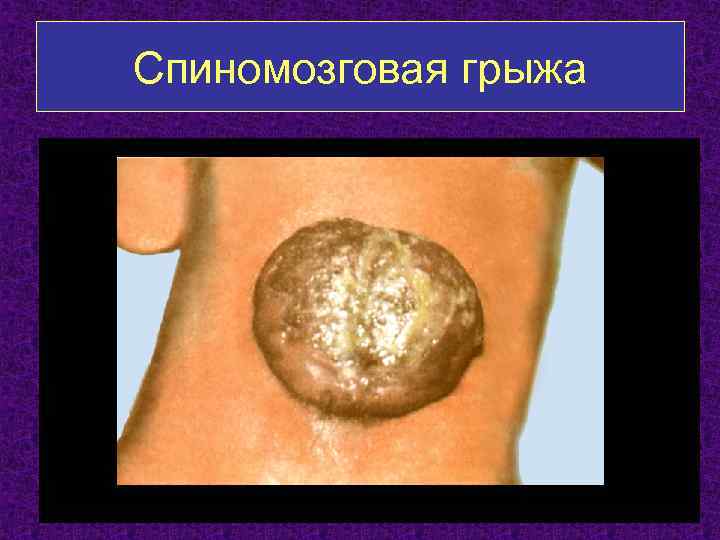 Спиномозговая грыжа 