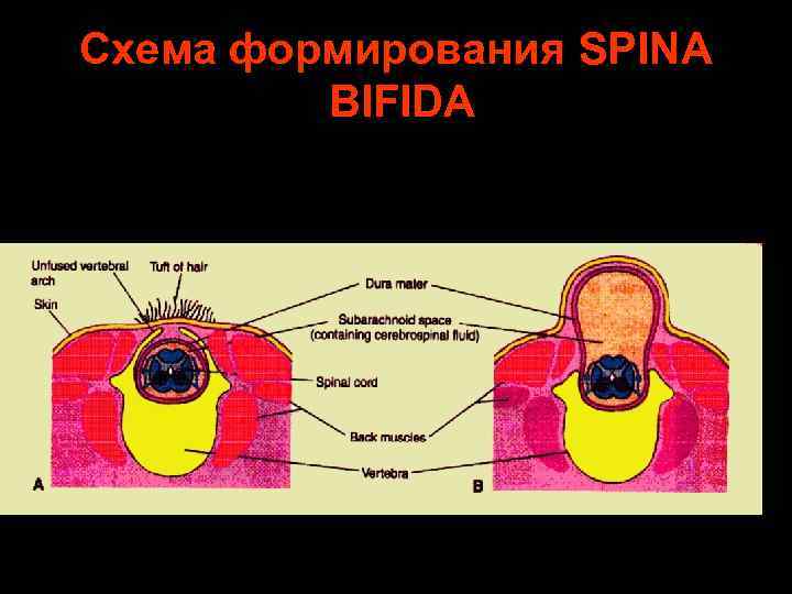 Схема формирования SPINA BIFIDA 