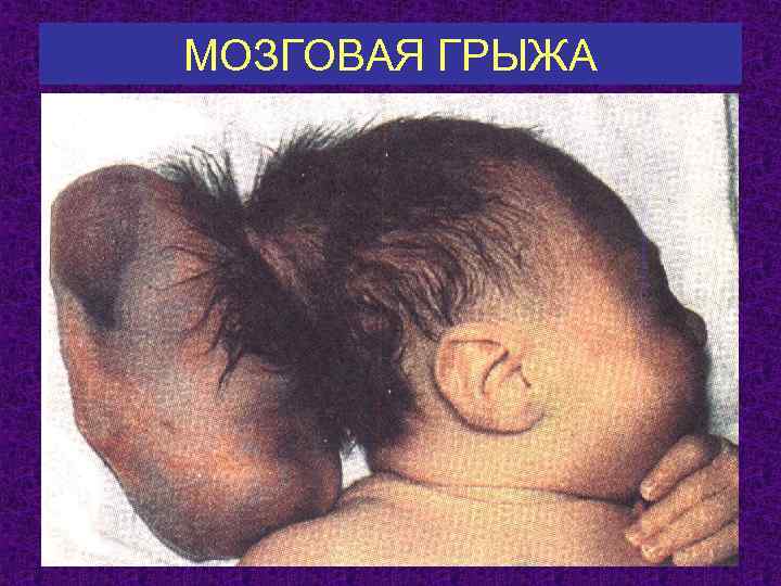 МОЗГОВАЯ ГРЫЖА 