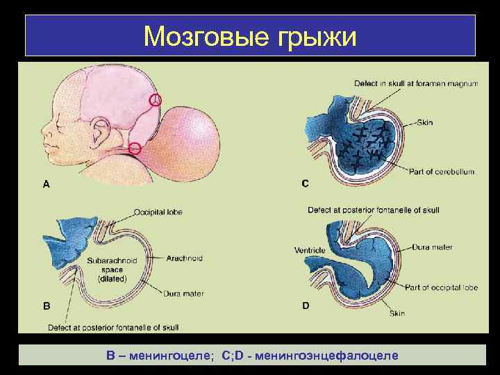 Мозговые грыжи В – менингоцеле; С; D - менингоэнцефалоцеле 