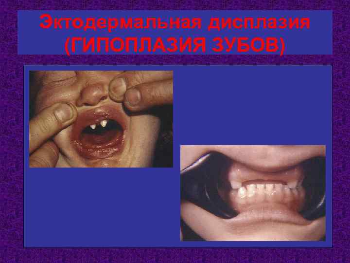 Эктодермальная дисплазия (ГИПОПЛАЗИЯ ЗУБОВ) 