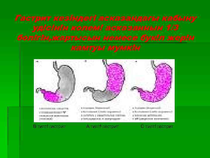 Гастрит кезіндегі асказандагы кабыну уд!с!н!н колем! асказаннын 1/3 бол!г!н, жартысын немесе бук!л жер!н камтуы
