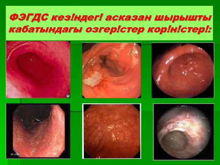 ФЭГДС кез!ндег! асказан шырышты кабатындагы озгер!стер кор!н!стер!: 