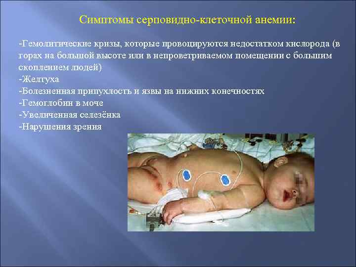  Симптомы серповидно-клеточной анемии: -Гемолитические кризы, которые провоцируются недостатком кислорода (в горах на большой