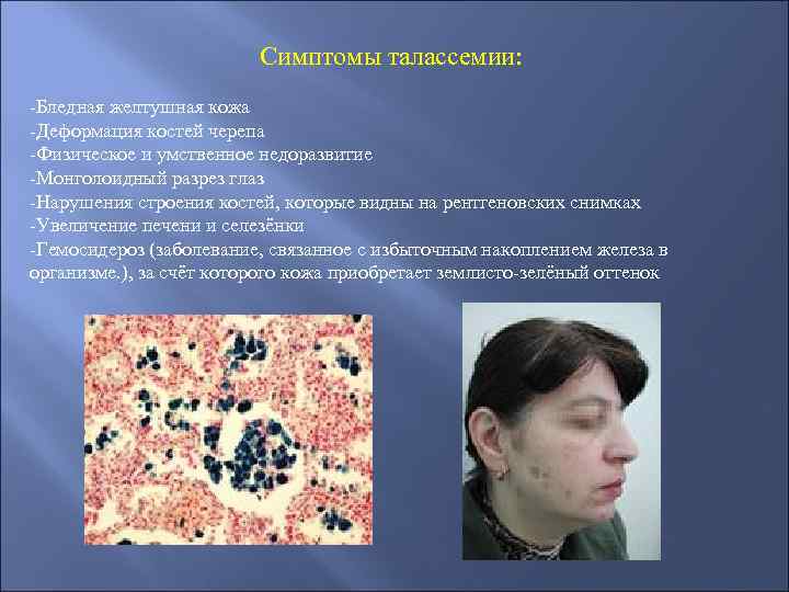 Симптомы талассемии: -Бледная желтушная кожа -Деформация костей черепа -Физическое и умственное недоразвитие -Монголоидный разрез
