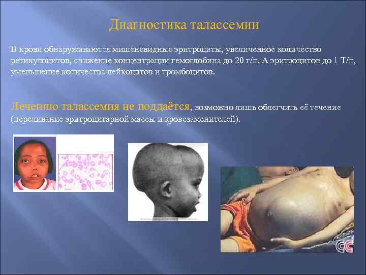 Диагностика талассемии В крови обнаруживаются мишеневидные эритроциты, увеличенное количество ретикулоцитов, снижение концентрации гемоглобина до
