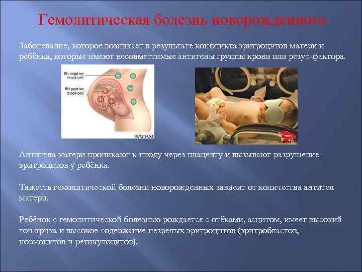 Гемолитическая болезнь новорожденного Заболевание, которое возникает в результате конфликта эритроцитов матери и ребёнка, которые