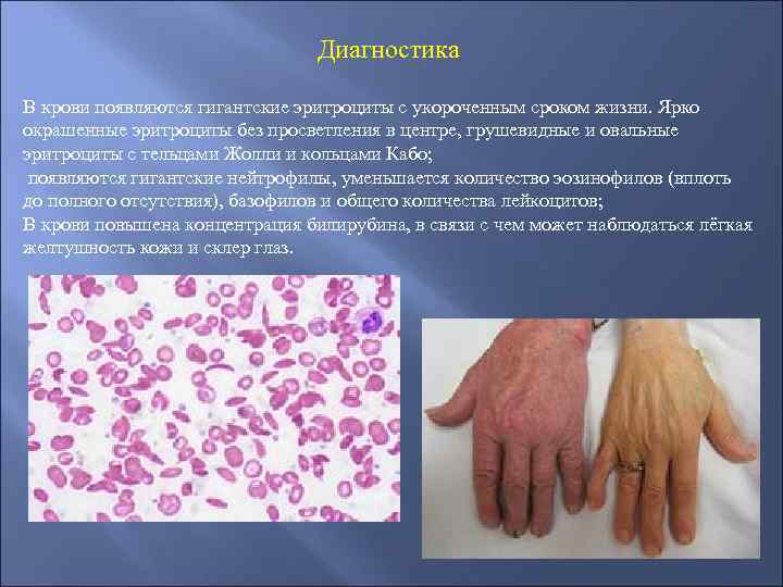 Диагностика В крови появляются гигантские эритроциты с укороченным сроком жизни. Ярко окрашенные эритроциты без