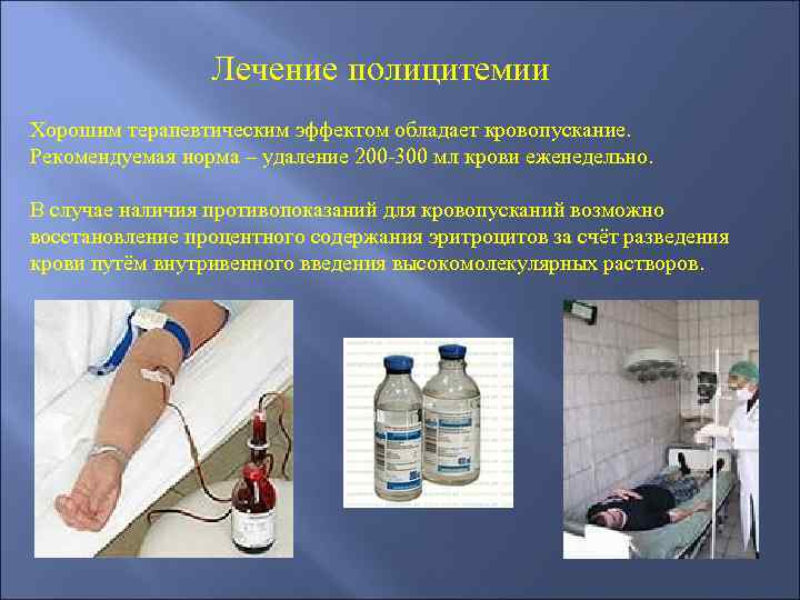 Лечение полицитемии Хорошим терапевтическим эффектом обладает кровопускание. Рекомендуемая норма – удаление 200 -300 мл