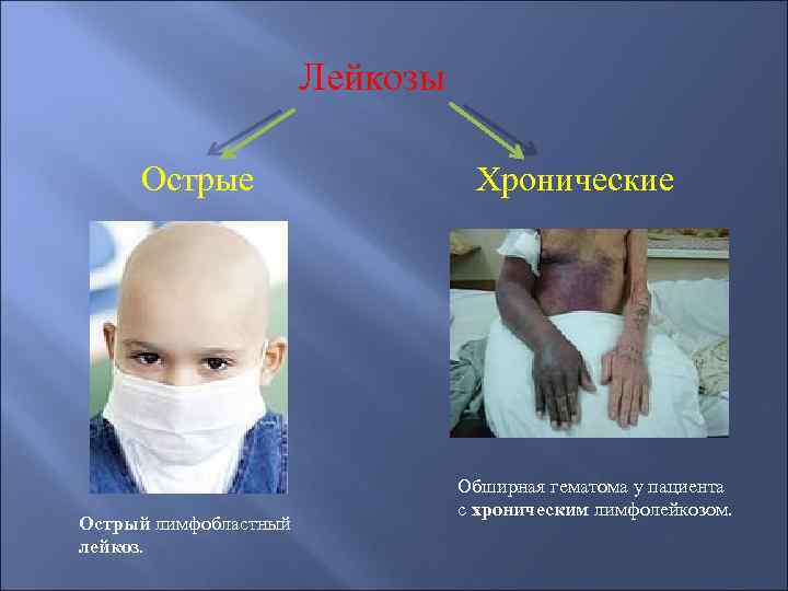 Лейкозы Острые Острый лимфобластный лейкоз. Хронические Обширная гематома у пациента с хроническим лимфолейкозом. 
