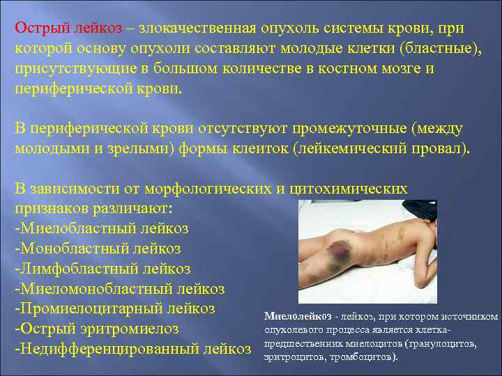 Острый лейкоз – злокачественная опухоль системы крови, при которой основу опухоли составляют молодые клетки