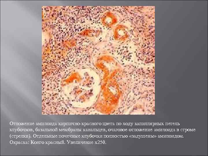 Отложение амилоида кирпично-красного цвета по ходу капиллярных петель клубочков, базальной мембраны канальцев, очаговое отложение