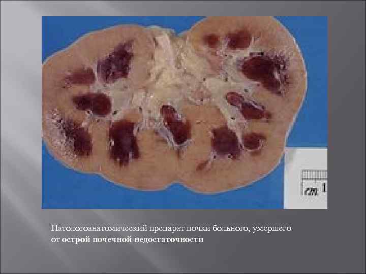 Патологоанатомический препарат почки больного, умершего от острой почечной недостаточности 