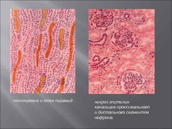  полнокровие и отек пирамид некроз эпителия канальцев проксимального и дистального сегментов нефрона. 
