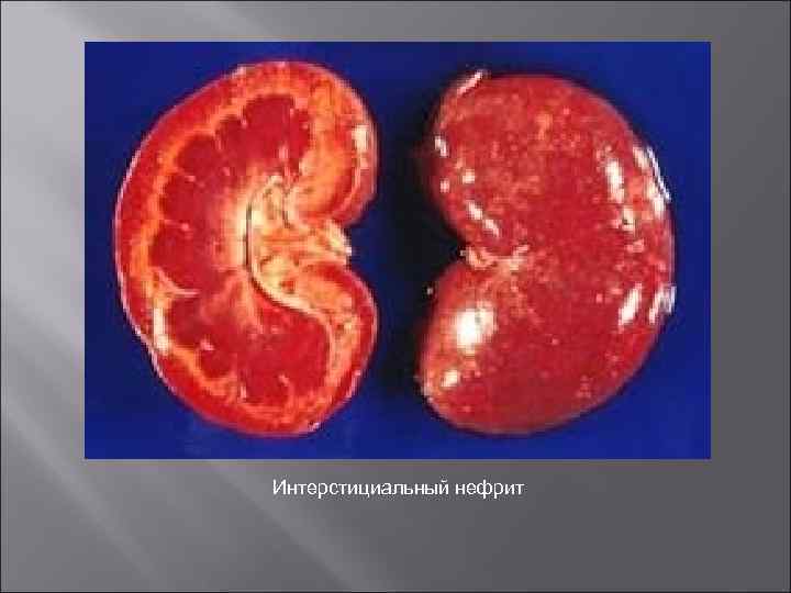 Интерстициальный нефрит 