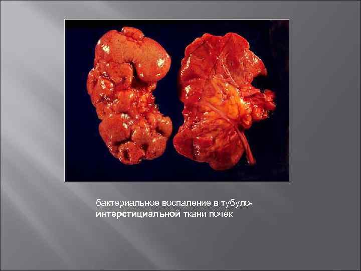 бактериальное воспаление в тубулоинтерстициальной ткани почек 