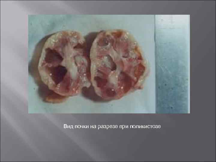 Вид почки на разрезе при поликистозе 
