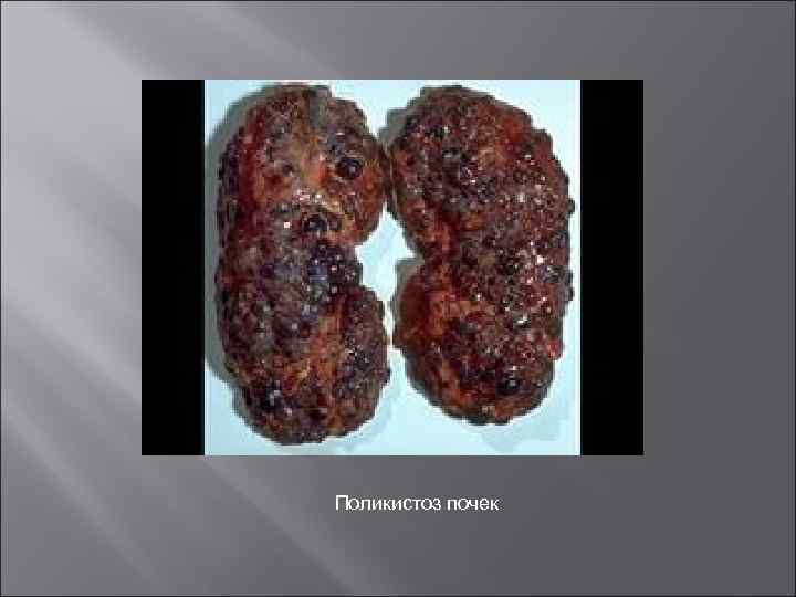 Поликистоз почек 