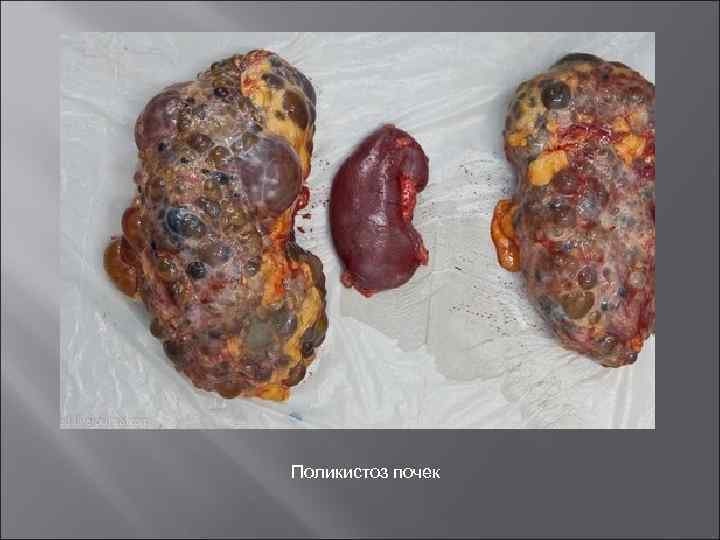 Поликистоз почек 