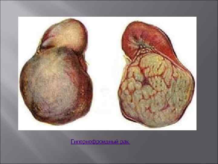 Гипернефроидный рак 