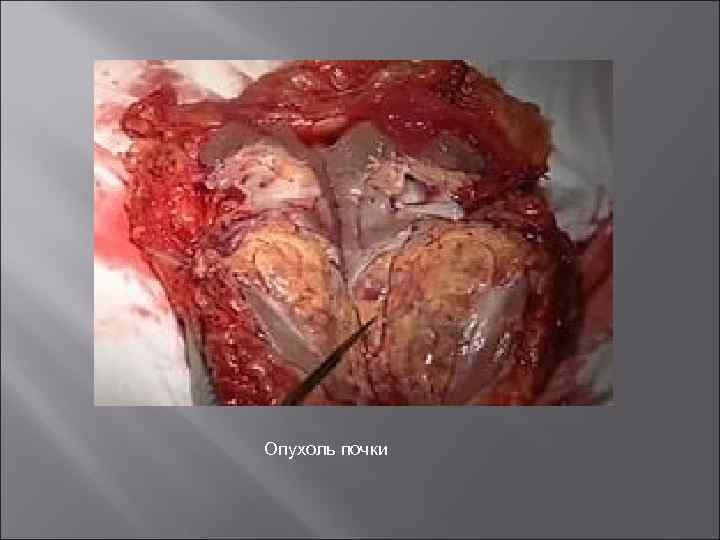 Опухоль почки 
