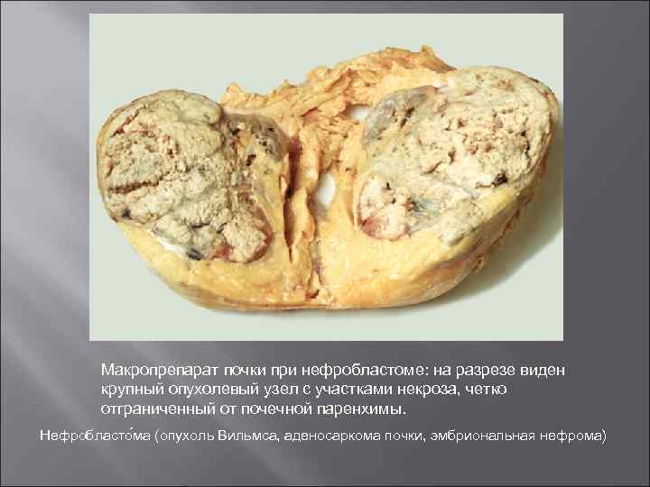 Макропрепарат почки при нефробластоме: на разрезе виден крупный опухолевый узел с участками некроза, четко