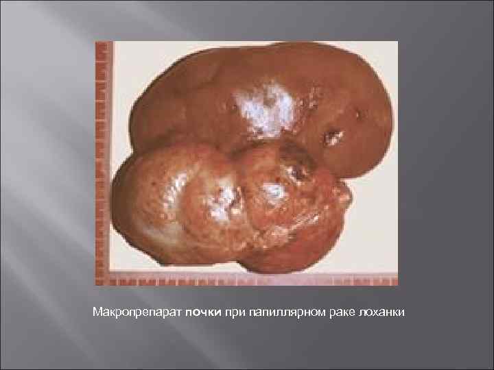 Макропрепарат почки при папиллярном раке лоханки 